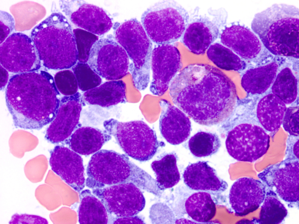 Blasts and plasmacytoid dendritic cells, bone marrow aspirate